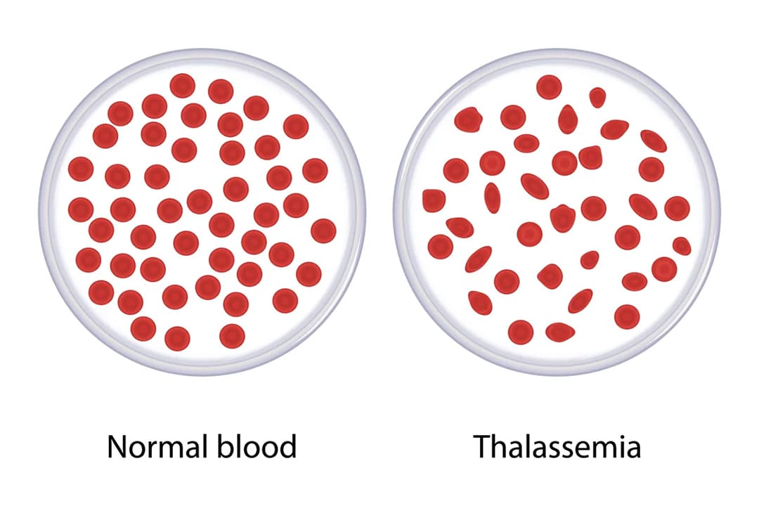 Understanding Thalassemia